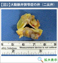 大動脈弁狭窄症の弁（二尖弁）