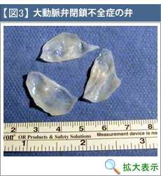 大動脈弁閉鎖不全症の弁