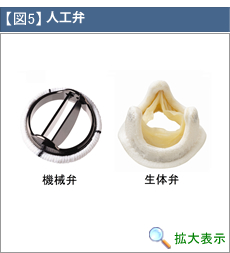 人工弁