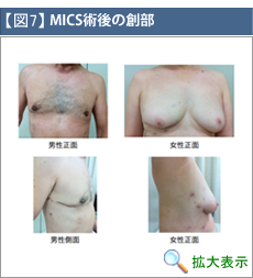 MICS術後の創部