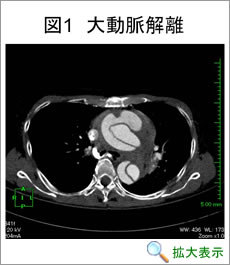 大動脈解離