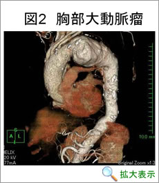 胸部大動脈瘤