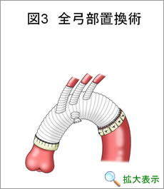 全弓部置換術