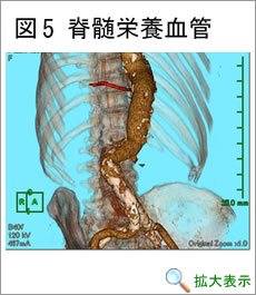 脊髄栄養血管