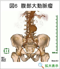 腹部大動脈瘤