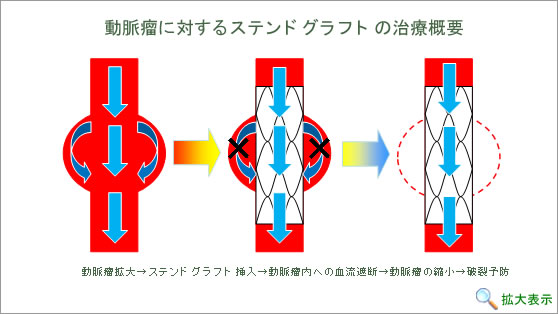 動脈瘤に対するステンドグラフトの治療概要