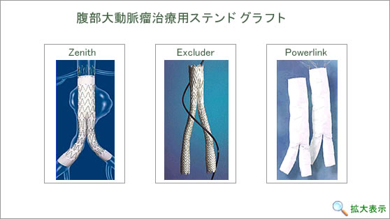腹部大動脈瘤治療用ステンドグラフト
