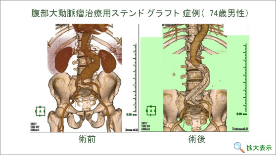 腹部大動脈瘤治療用ステンドグラフト症例（74歳男性）
