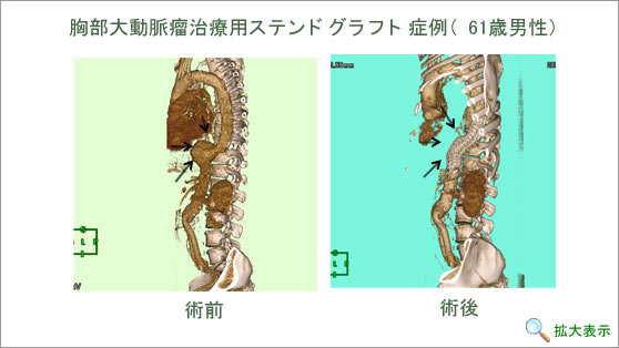 胸部大動脈瘤治療用ステンドグラフト症例（61歳男性）